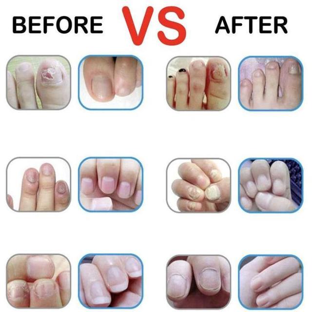 CLINAIL™ : Advanced Fungal Nail Repair Pen