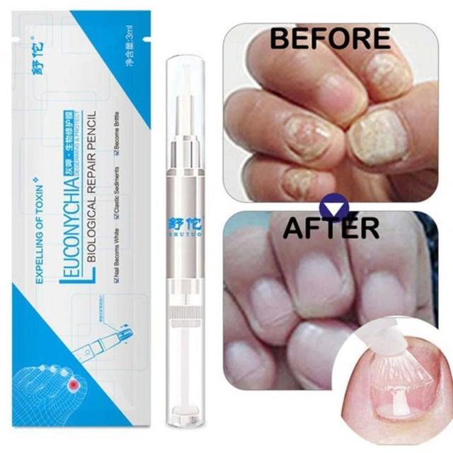CLINAIL™ : Advanced Fungal Nail Repair Pen