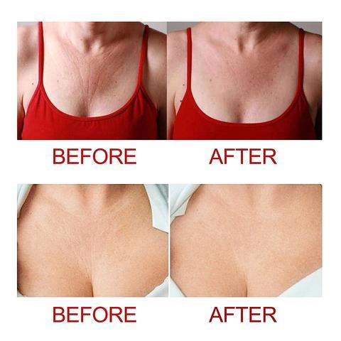 CHESTER™ : Anti-Wrinkle Chest Smoother