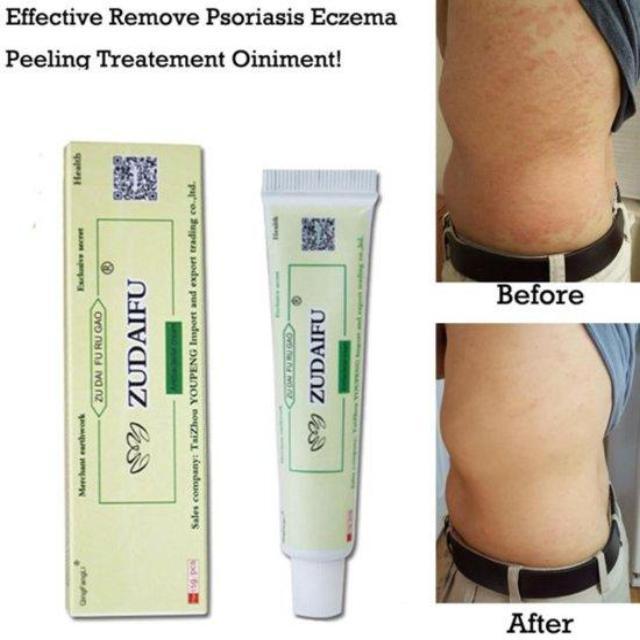 ECZIGON™ : Psoriasis and Eczema Cream